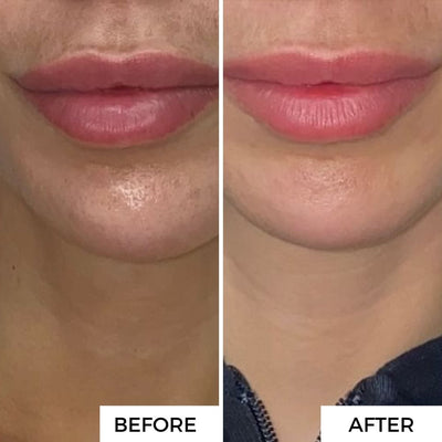 2. Fades Hyperpigmentation