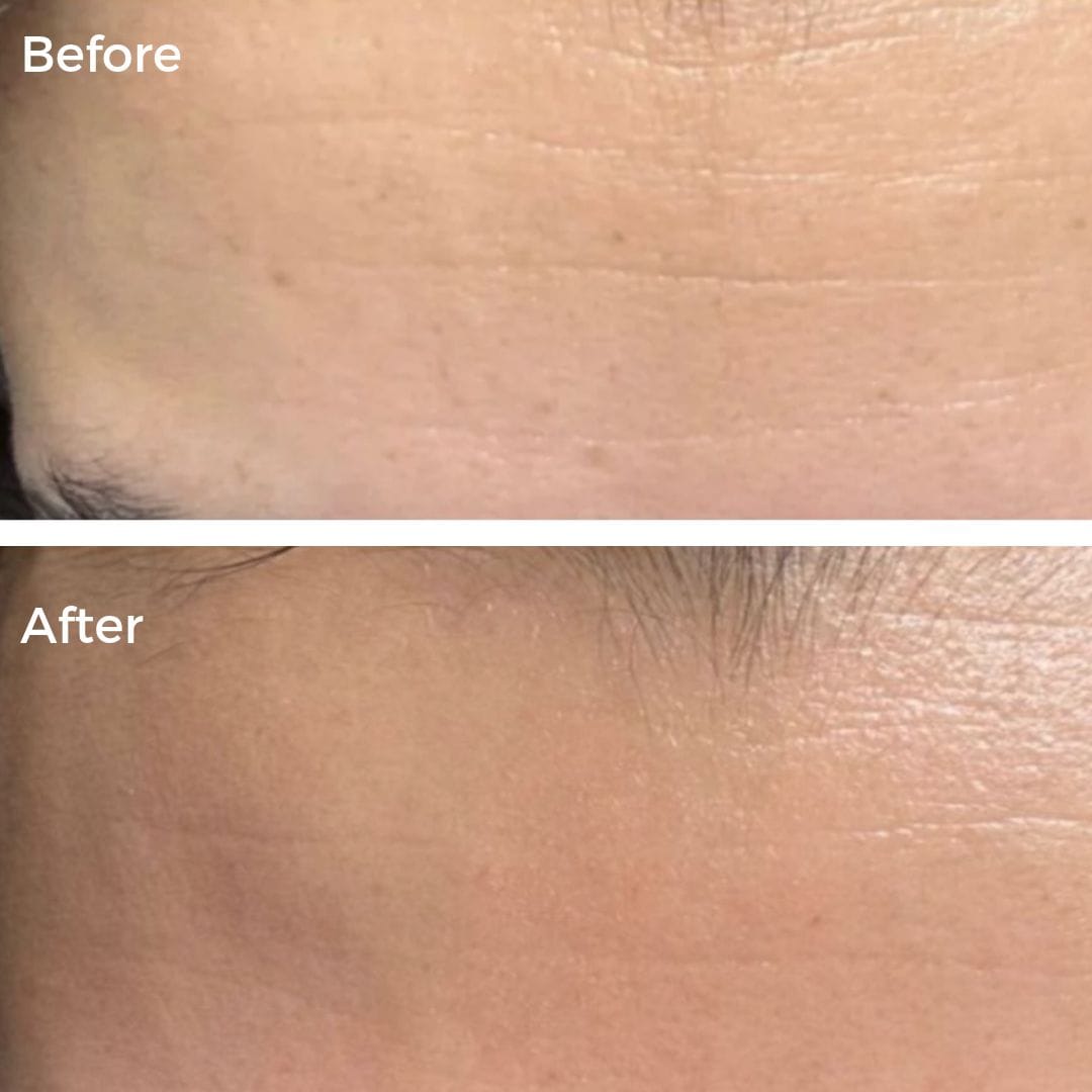 Customer before and after: forehead fine lines and dark spots visibly softened